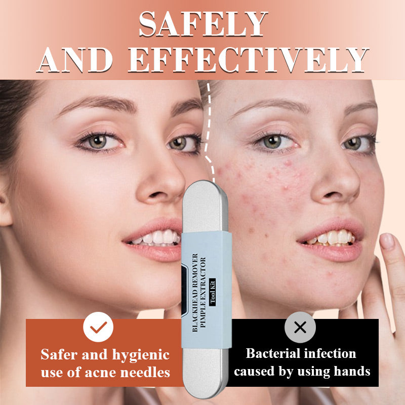 💓2026 HOT SALE 50% OFF💥Medical Grade Blackhead Extraction Tool Kit